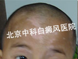 白癜风护理要注意什么